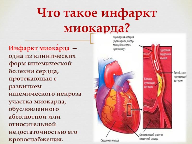 Современное лечение инфаркта миокарда - обзор от магазина медтехники NOVOKOM.SU